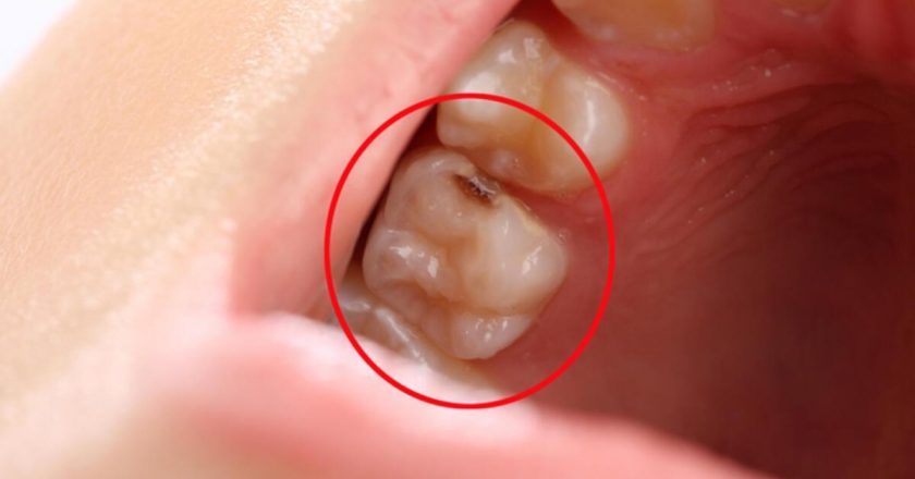 Bu yağ çürük diş ağrısına iyi geliyor! Çürük Diş Ağrısına Ne İyi Gelir, Nasıl Geçer? Diş Çürüğü Ağrısı Evde Tedavi Edilir Mi?